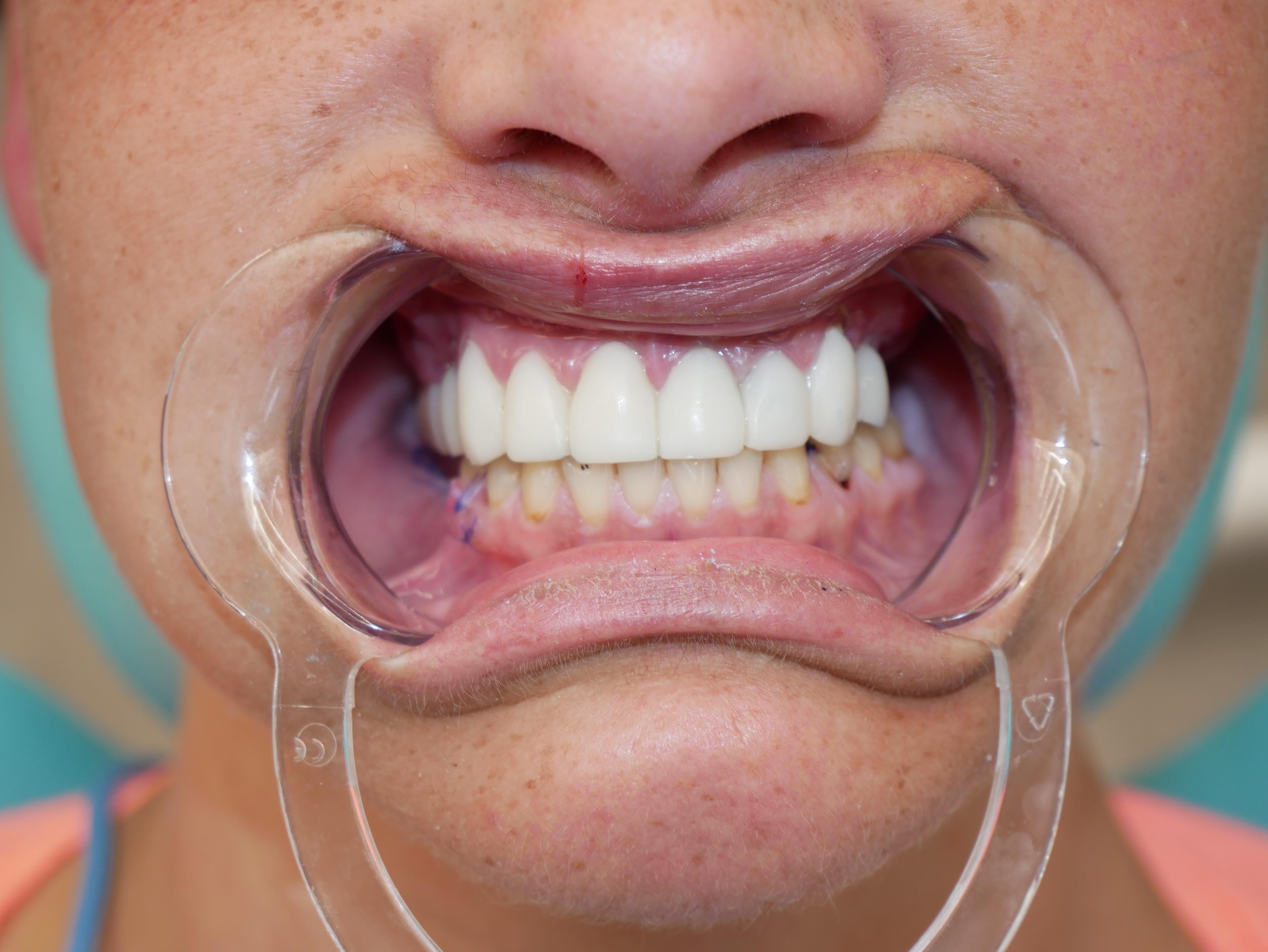 The same patient's smile after treatment