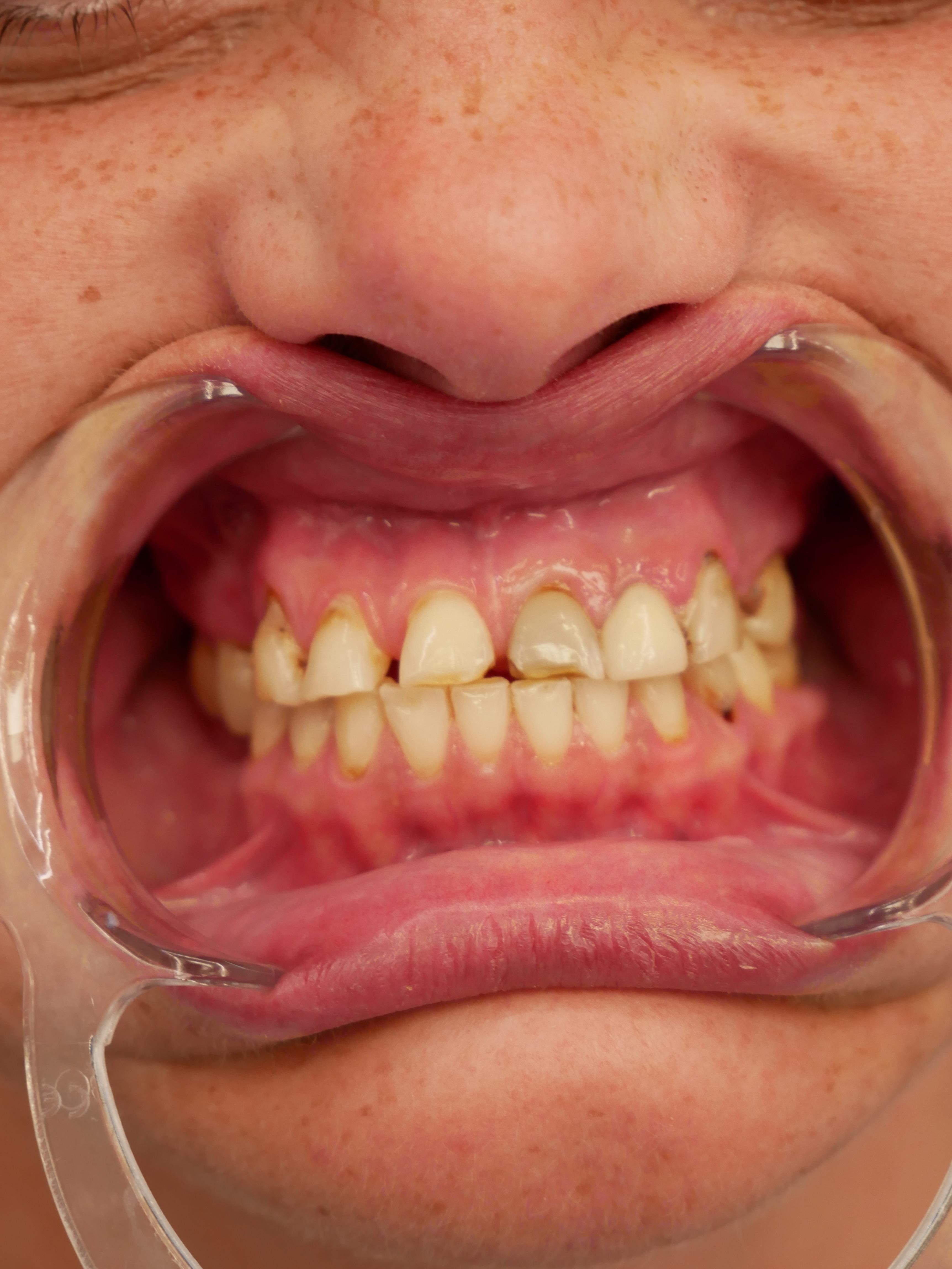 Patient's smile before dental treatment